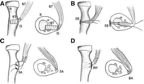 Single Incision Distal Biceps Repair Using the …