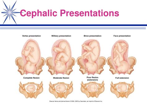 Single live intrauterine pregnancy in cephalic presentation. .  <a href=https:/...
