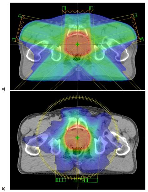 Single-Arc IMRT? - IOPscience - Institute of Physics