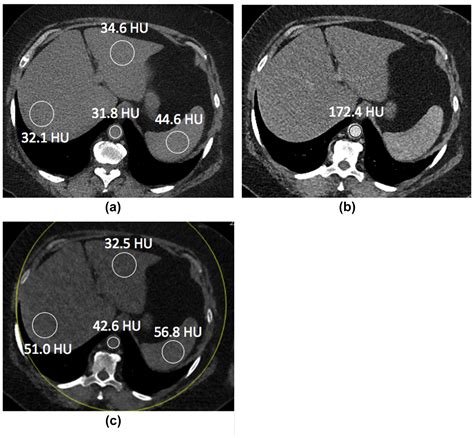 Single-energy non-contrast hepatic steatosis criteria applied to ...