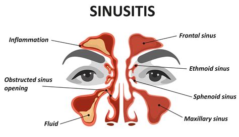 Sinusitis UKF IMS