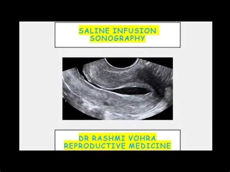 Sis labs test.  Each tablet is labeled to contain.  Saline sonograms and F...