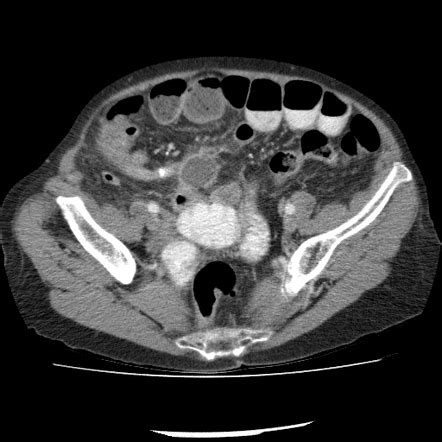 Six Cases of Perforated Appendicitis During Clozapine Treatment