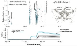 Size Distribution of Air Bubbles Entering the Brain during ... - PLOS