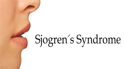 Sjogren pronunciation. Things To Know About Sjogren pronunciation. 