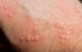 Skeeter sendromu Vikipedi.