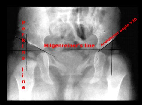 Skel Rad- Hip and Pelvis, part of knee (7/1/19) - Quizlet