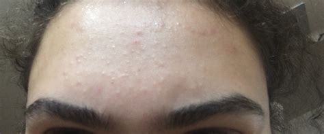 Skin Discoloration on the Forehead Healthfully