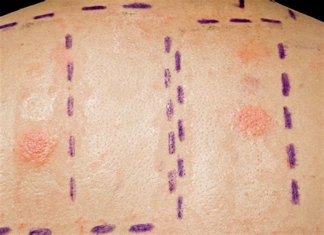 Skin Patch Testing for Allergies What to Expect