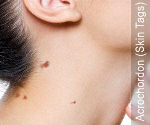 Skin Tags (Acrochordon) - Drugs.com