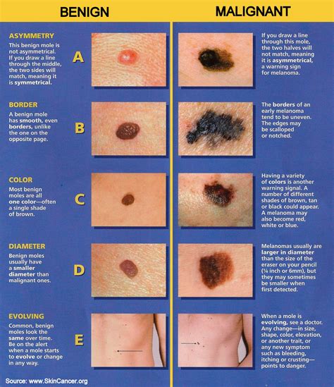 Skin cancer clinic or GP: Who should you see if you …