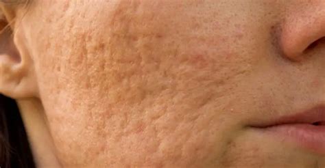 Skin indentations. The inflammation damages skin, ... Acne can mark the skin in a number of ways, leaving discoloration, indentation, or raised scars. Thankfully, there are several treatments to improve all kinds. 