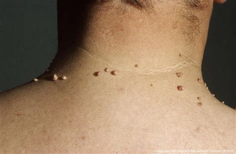 Skin tag Unbearable awareness is
