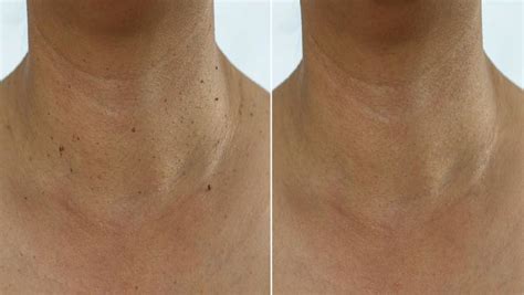Skin tags in pregnancy What causes them and how to remove them