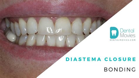 Skull charting: Diastema - YouTube