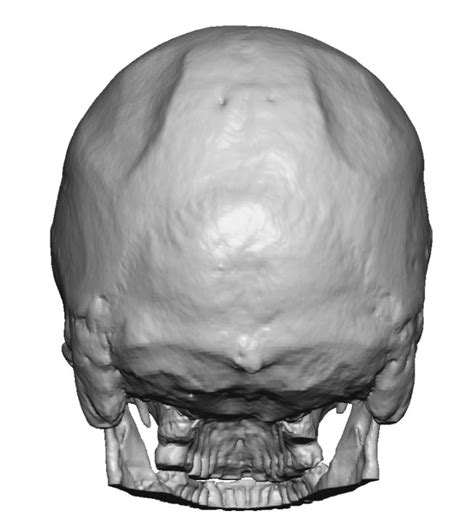 Fractures of the skull base are not readily 