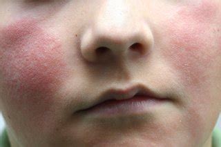 Slapped cheek disease Health Navigator NZ