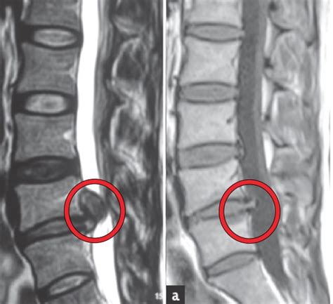 Slip Disc Surgery Recovery Time