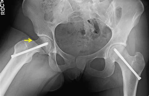 Slipped Capital Femoral Epiphysis (SCFE) Patient