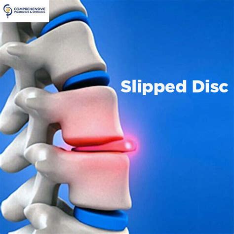 Slipped Disc Picture Image On Medicinenet Com