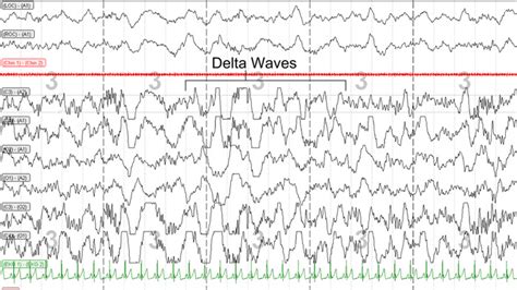 Slow wave sleep is the stage that