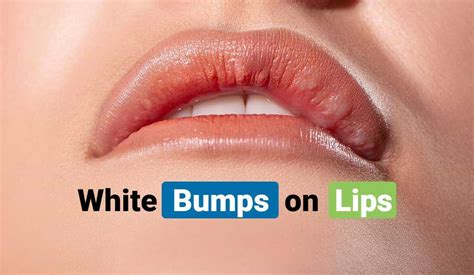 Small White Dots on Lips, Causes, Pictures & Treatment