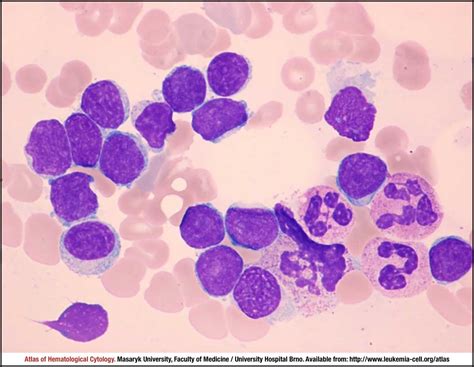 Small cell (CLL-like) variant - CELL - Atlas of Haematological …