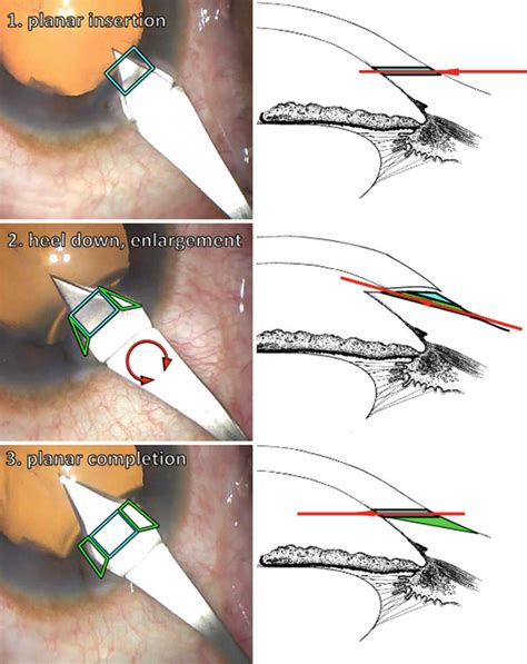 Small incision cataract surgery manual phaco. - Kymco like 50 125 komplette werkstatt reparaturanleitung.