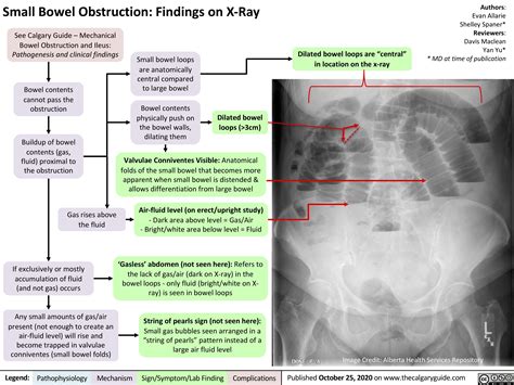 SmallBowelObstructionfindingsonXRay Calgary Guide