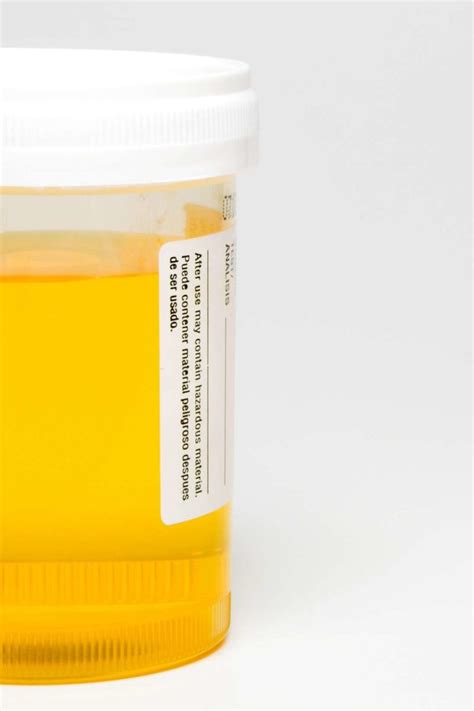 Smell of sulphur in urine. By Mayo Clinic Staff. Most changes in urine odor are temporary and don't mean you have a serious illness, particularly if you have no other symptoms. When an unusual urine odor is caused by an underlying medical condition, there are other symptoms too. If you're concerned about the odor of your urine, talk to your doctor. 