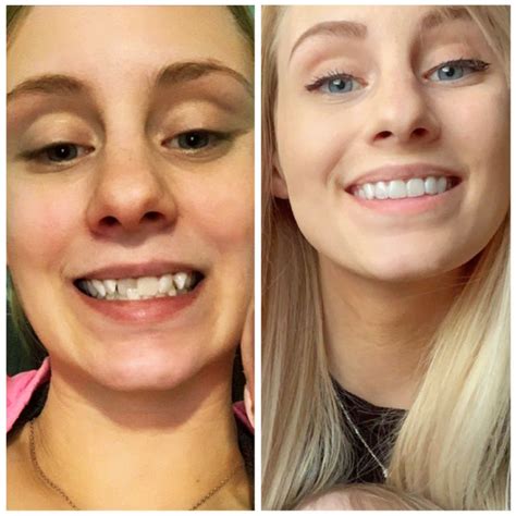 Smile direct club before and after. Feb 1, 2024 ... Smile Direct Club's decline – The in-depth analysis you need before choosing Invisalign. Smile Direct Club ... after filing for bankruptcy. This ... 