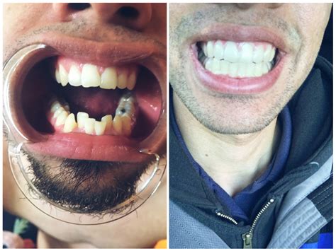 Smile direct retainers. The most common meaning of “smile now, cry later tattoos” is to live life to the fullest now and worry about the consequences later. The most popular styles of the tattoo feature s... 