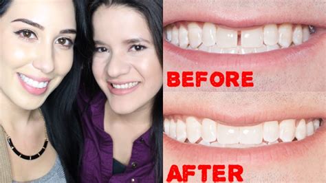 Smilecareclub cost. SmileCareClub Clear Braces... SmileCareClub Clear Braces Review - Nashville, TN. More about SmileDirectClub. mdean9999; Not Sure $1,800; At Home, Nashville, TN Reviews you can trust, from real people like you. How it works ... 