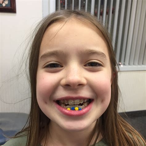 Smiley face braces. Feb 28, 2020 · By Smiley Face Braces Team February 28th, 2020 0 Comm. 28 February If you have any signs of a misaligned bite or crooked teeth, it is wise that you see an orthodontist as soon as possible. 