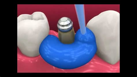 Smyl Manatee - Dental Implant Procedure - YouTube