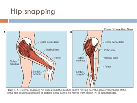 Snapping hip behandling