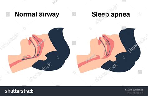 Snoring is symptom of what