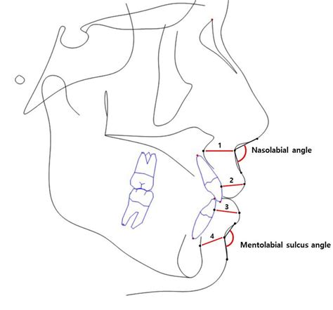 Soft Tissue Changes Following the Extraction of Premolars in …