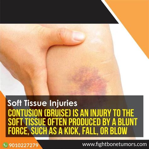 Soft tissue injury definition and meaning - Collins Dictionary