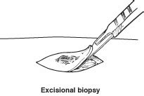 Soft-Tissue Biopsy - Foot Health Facts