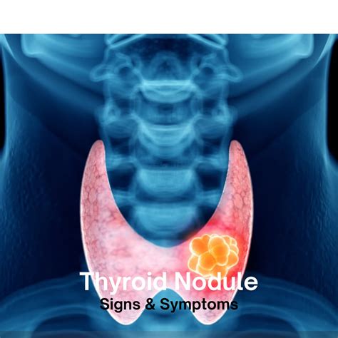 Solid thyroid nodule.  Learn about symptoms, diagnosis, and treatment options.  3 ...