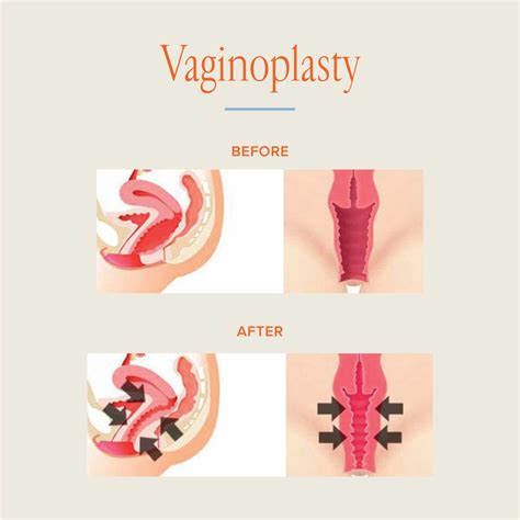 Something post op pussy for the first time.  Post-Operative Vaginoplasty Guid...