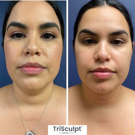 Feb 29, 2024 · A: Sono Bello TriSculpt procedure, which is advanced laser lipolysis, starts at $1395 per area. For others, including TriSculpt E/X Venus Freeze and Venus Legacy, the price starts at $2995 per area. The company offers different payment plans where no interest will be charged if you pay the whole amount within 6 to 12 months. . 