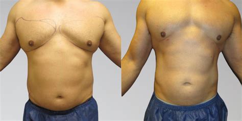 Sono bello trisculpt before and after pictures. Within 24 hours of the liposuction procedure, the body's natural healing mechanisms produce proteins that help promote skin retraction. One of the most meaningful benefits of Sono Bello’s TriSculpt ® laser-assisted fat removal technique is that it kickstarts natural collagen production, speeding up the skin tightening process. 