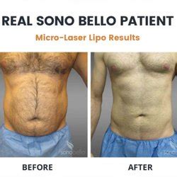 These complaints have proven that you need to be prepared when you want Sono Bello to contour your body. You can make a complaint directly to the Orlando office at: 407-354-4600. Or file a complaint directly on the official website. They can pull your file and make a complaint. . 