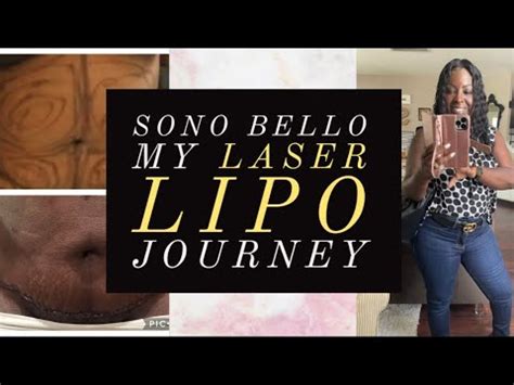 Sonobello trisculpt cost. Sono Bello makes no guarantees that smart lipo will be used in a particular center or patient treatment. ... The secret is TriSculpt Micro-Laser Liposuction that … 