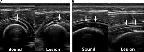 Sonographic Evaluation of the Posterior Interosseous Nerve i ... - LWW