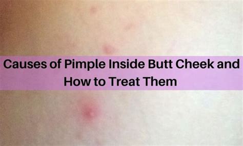 The most obvious symptom of a boil located in your butt crack is a red, painful bump in your skin. It may vary in size from a cherry pit to a walnut. The boil may feel warm and swell as it fills .... 