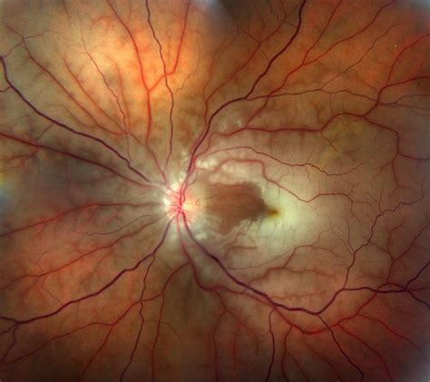 Southeastern retina. Southeastern Retina Associates is a medical group practice located in Knoxville, TN that specializes in Ophthalmology, and is open 5 days per week. 