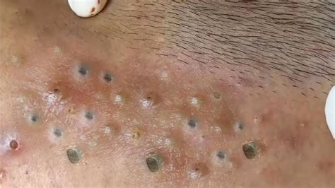 Deep Blackheads Removal - Pimple Popping Video. Acne treatment.htt